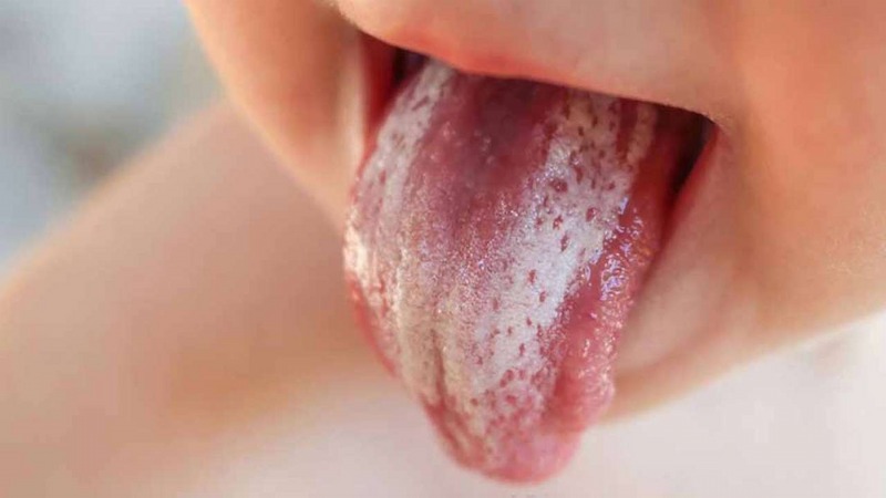 Nấm miệng thường biểu hiện bằng những mảng, đốm, dày, có màu trắng hoặc ngà trong miệng